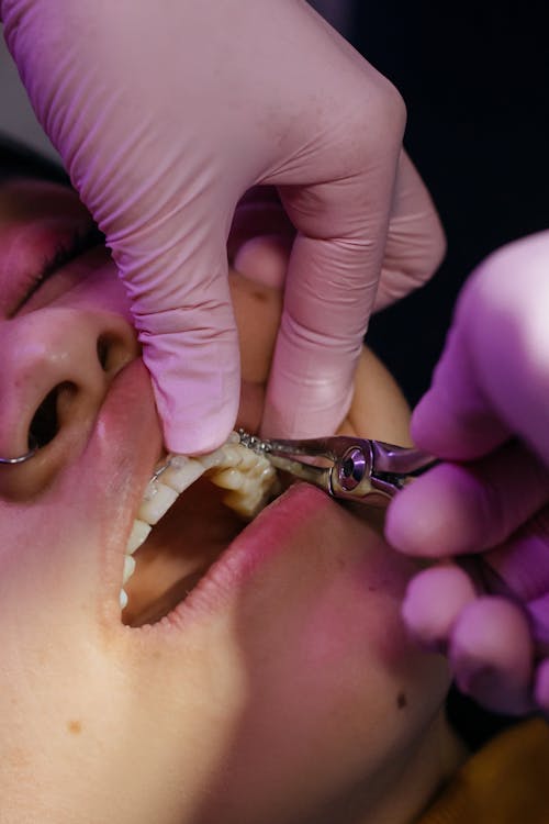 Root Canal Treatment in Townsville