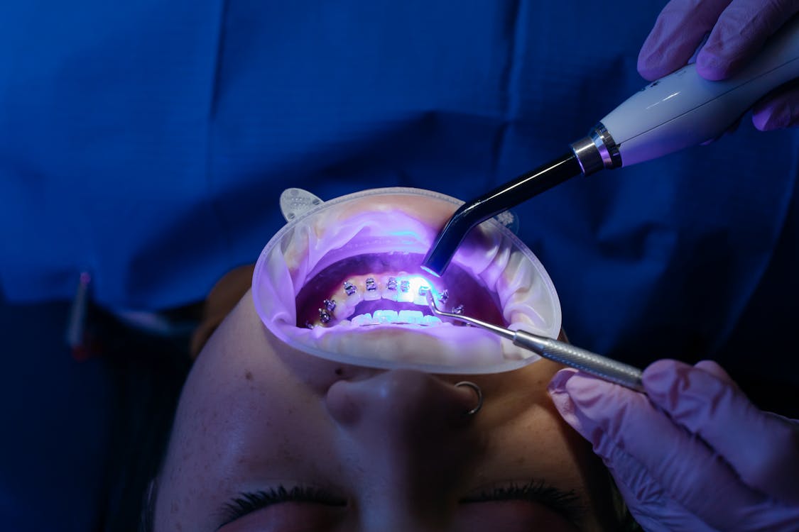 Take-Home Teeth Whitening in Townsville