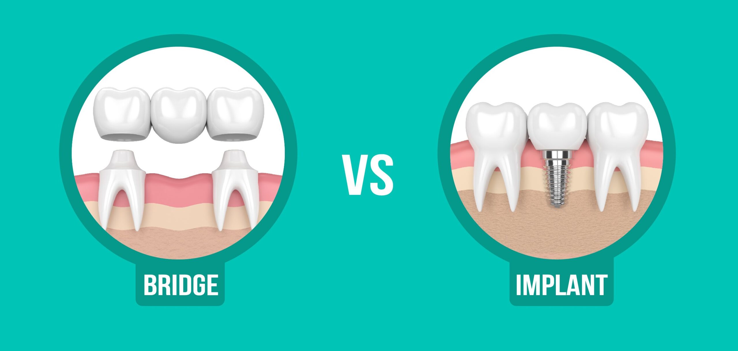 Dental Bridge vs Implant