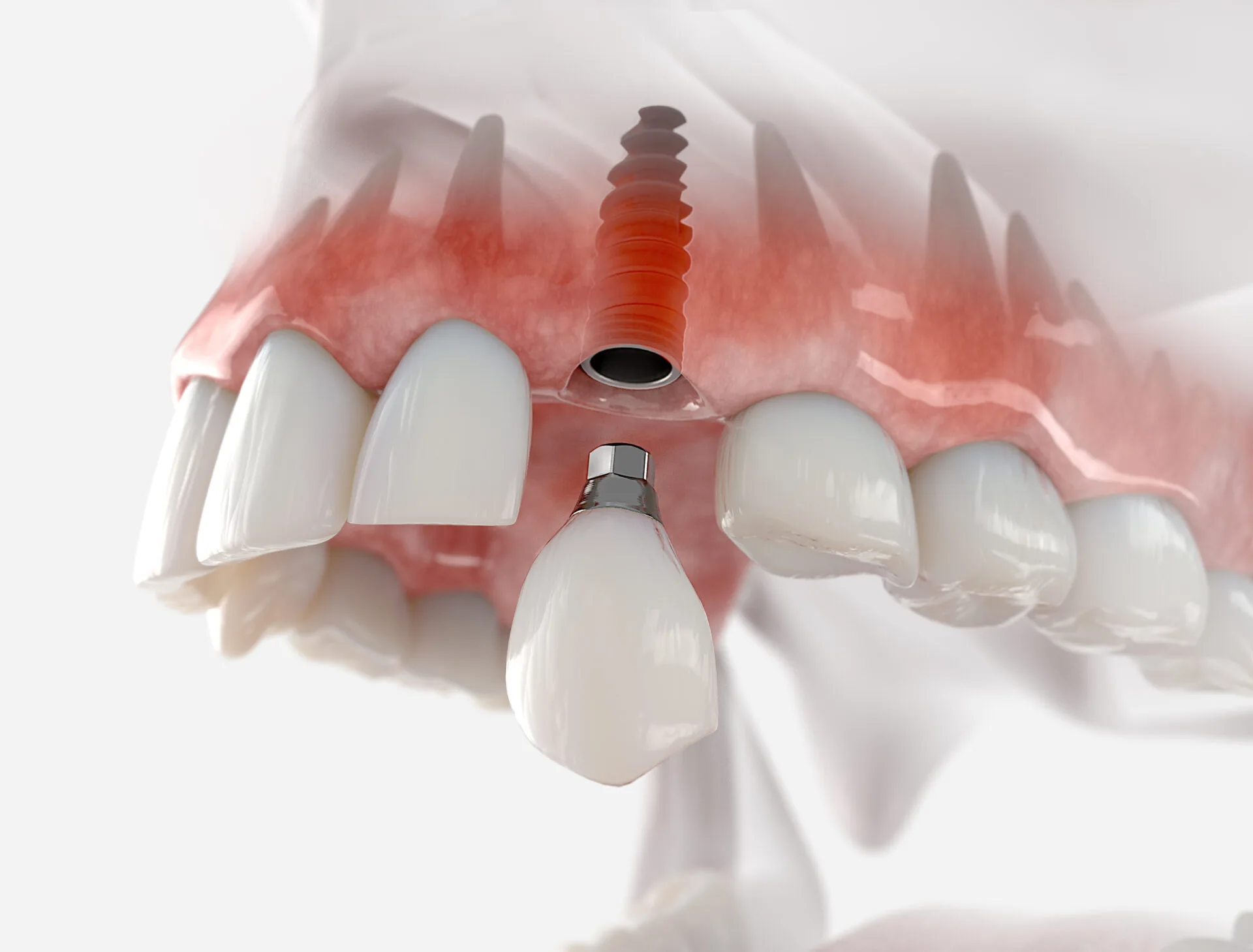 Dental Implant Treatment in Townsville Dental Implant Treatment in Townsville
