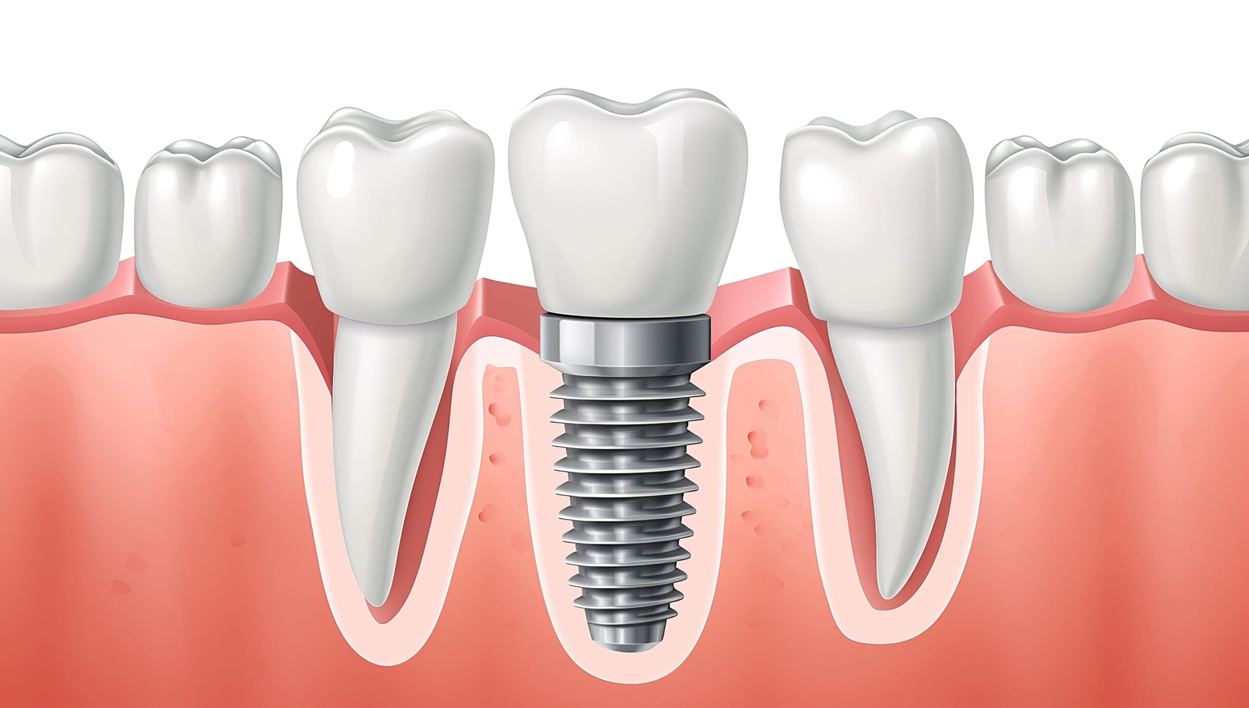 Dental Implant