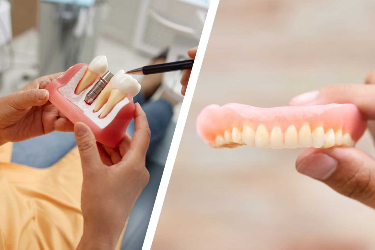 Implants vs Dentures