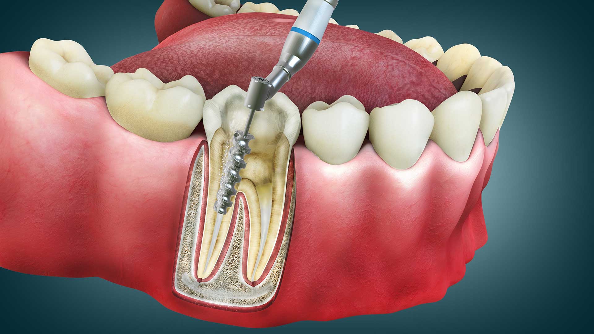 Root Canal Treatment Townsville