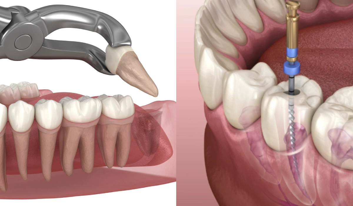 Root Canal vs Extraction