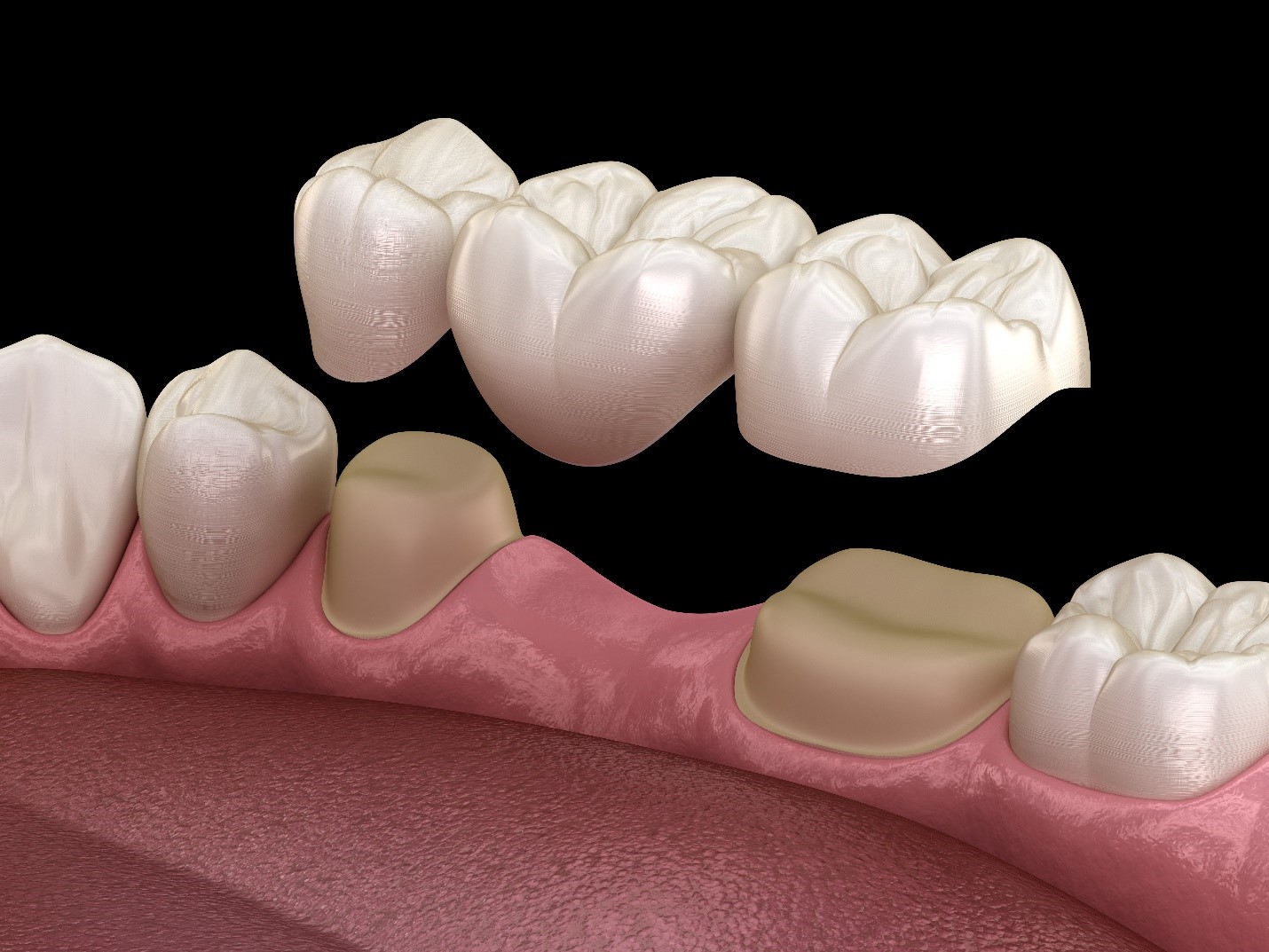 Traditional Dental Bridge