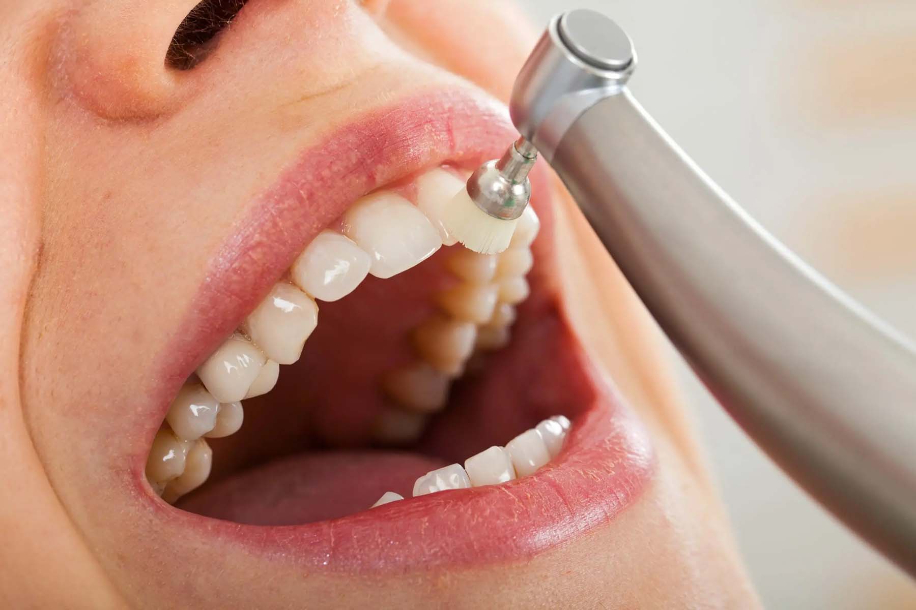 dental cleaning cost Townsville