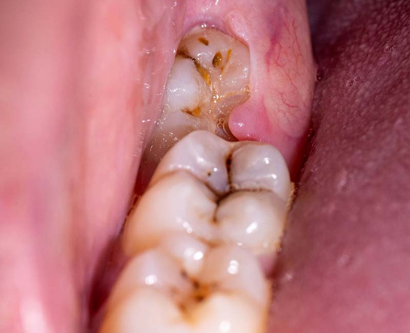 impacted wisdom teeth