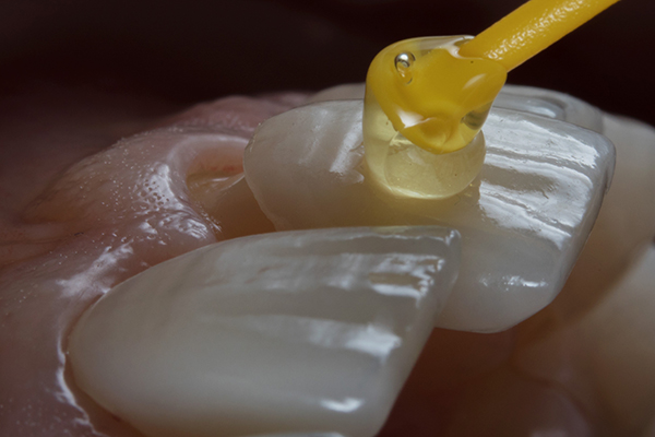 porcelain veneers townsville 2