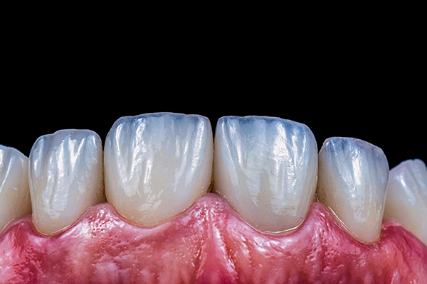 porcelain veneers Townsville 3