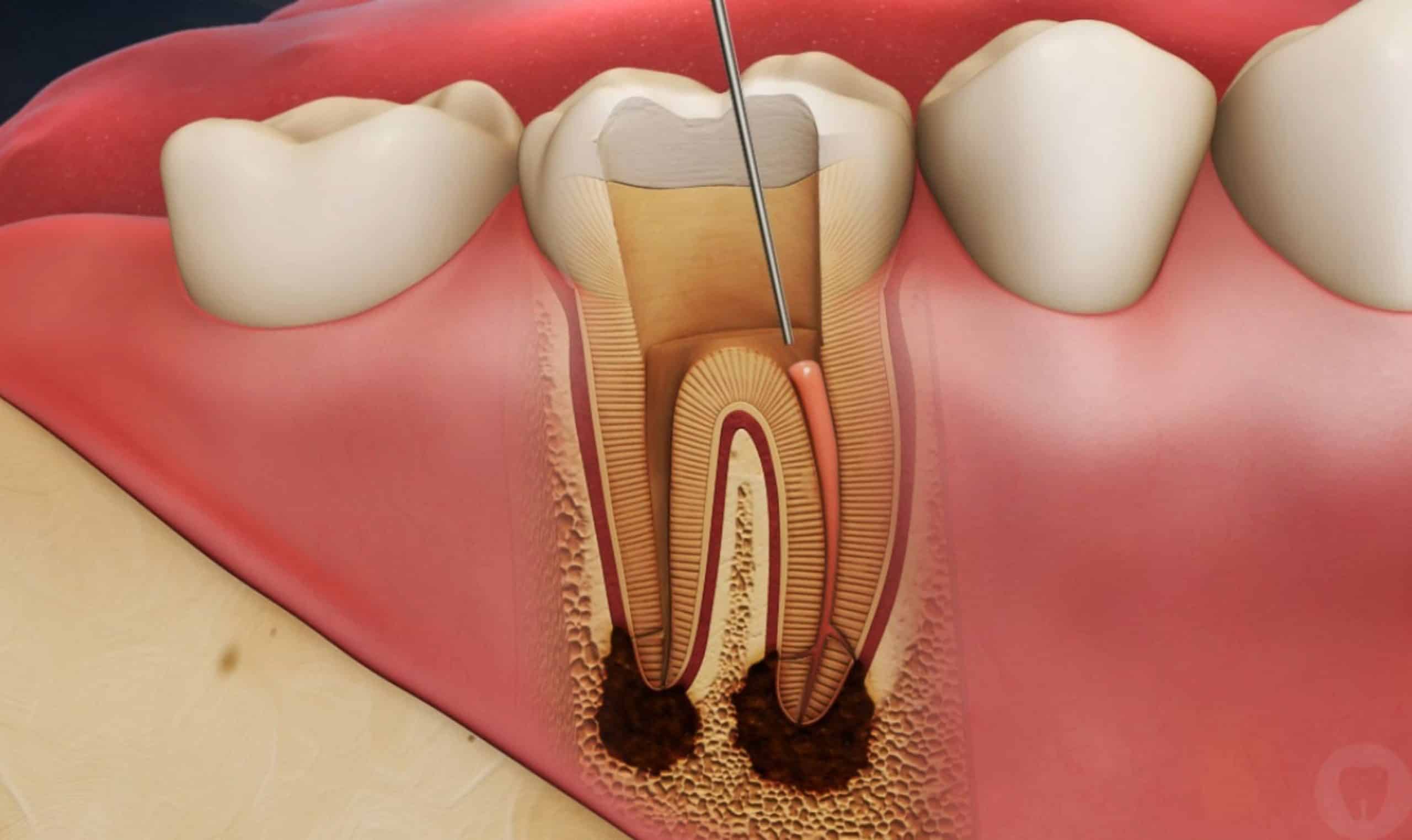 Root canal treatment cost