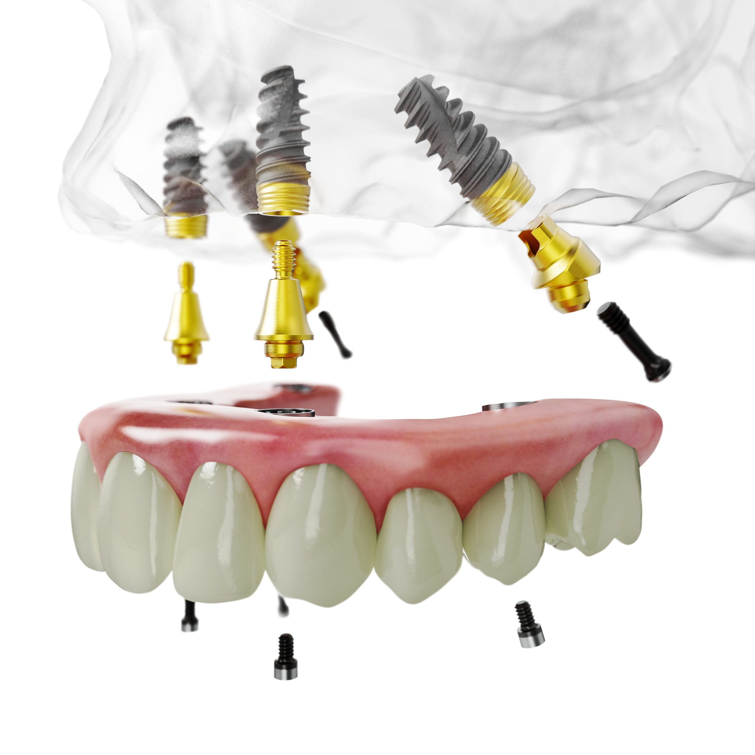 How painful is all on 4 dental implants?
