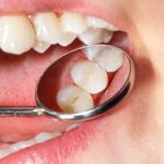 dental fillings townsville